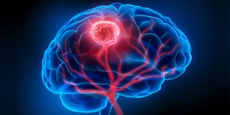 brain cancer