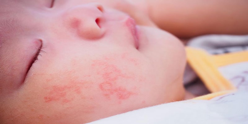 toddlers allergies